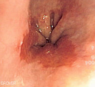 Barretts esophagus.jpg