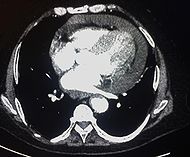 CT pericardial effusion.jpg