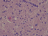 Pathology Brain Radiation Necrosis 3.jpg