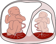 Twin to Twin transfusion syndrome.svg