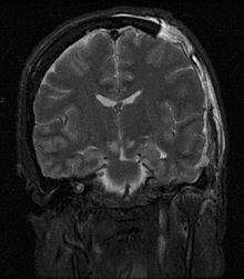 Brain herniation MRI.jpg