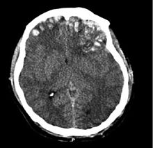 Brain trauma CT.jpg