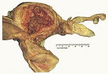 Endometrial hyperplasia.jpg