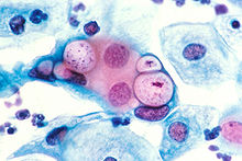Pap smear showing clamydia in the vacuoles 500x H&E.jpg