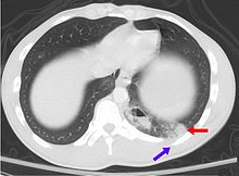 Pulmonary contusion CT arrow.jpg
