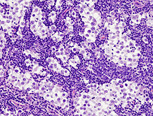 Testicular seminoma (1) nodal metastasis.jpg